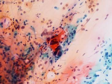 写真2：子宮頸癌検診の細胞診標本（悪性例：中央の大きな細胞が癌細胞）