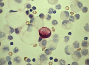 写真4：写真１の細胞を拡大したもの。中央の赤く染まっているのが胃癌細胞。